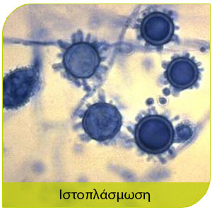 ασθένεις στον άνθρωπο από πτηνά και ιστοπλάσμωση