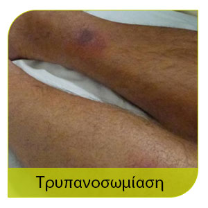 ασθένεις απο τη μύγα και τρυπανοσωμίαση